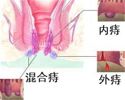 痔疮