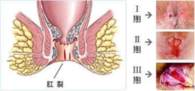 肛裂