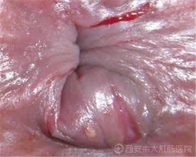 肛裂