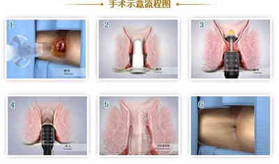 pph痔疮手术示意图