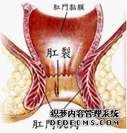 肛裂便血
